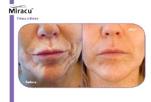 Surgical Facelift results on your lunch hour at SKN Marquette at PuR Salon